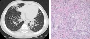 Diagnosis and Management of the Systemic Juvenile Idiopathic Arthritis Patient with Emerging Lung Disease.