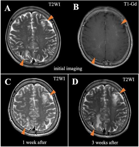 Long-term survival from progressive multifocal leukoencephalopathy in living-donor liver transplant recipient with preformed donor-specific antibody.