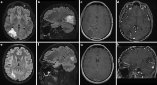 Tumefactive Demyelinating Lesion Around a Developmental Venous Anomaly : A Rare Association.