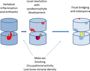 Syndesmophyte Growth in Ankylosing Spondylitis: from Laboratory to Bedside.