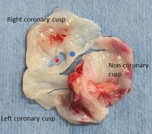 Safety and efficacy of aortic valvuloplasty for de novo aortic insufficiency in patients with a left-ventricular assist device.