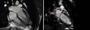 Left Atrial Phasic Function via Cardiac Magnetic Resonance Imaging in Patients with Duchenne Muscular Dystrophy.