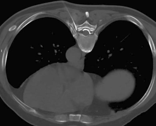 Effect of CT-Guided Repeated Pulsed Radiofrequency on Controlling Acute/Subacute Zoster-Associated Pain: A Retrospective Cohort Study.