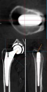 Evaluation of the reproducibility of preoperative three-dimensional computed tomography planning for posterolateral approach total hip arthroplasty.