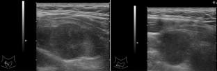 An extremely rare case of nonfunctioning parathyroid carcinoma occurring in a parathyroid adenoma.