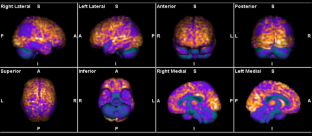 FDG–PET in patients with autoimmune encephalitis: a review of findings and new perspectives