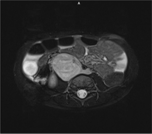 "The Red Flags" in Clinical Approach to Acute Ataxia-the Experience in Cohort of 76 Children.