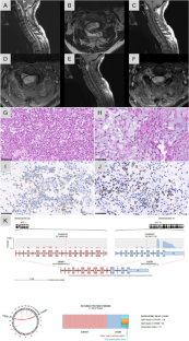 An extracranial CNS presentation of the emerging "intracranial" mesenchymal tumor, FET: CREB-fusion positive.