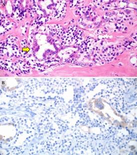 Update on C-Cell Neuroendocrine Neoplasm: Prognostic and Predictive Histopathologic and Molecular Features of Medullary Thyroid Carcinoma.