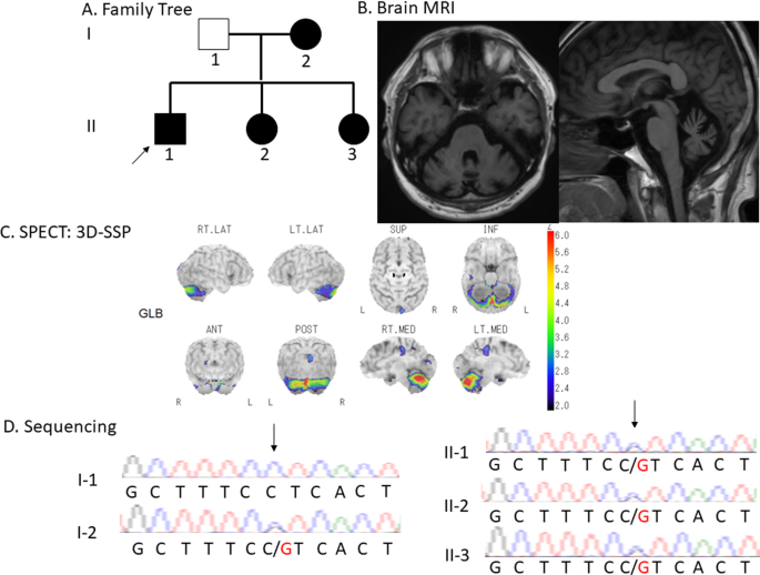 A heterozygous GRID2 mutation in autosomal dominant cerebellar ataxia.