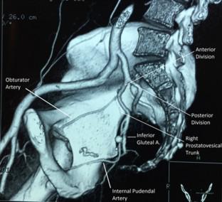 Prostatic Arterial Embolization for Treatment of Lower Urinary Tract Symptoms Associated with Benign Prostatic Enlargement.