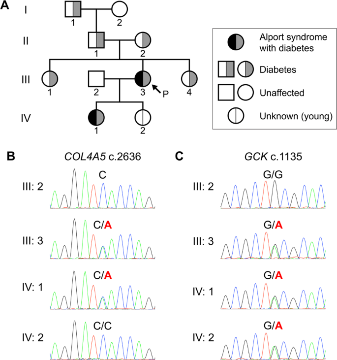 Pathogenic variants of Alport syndrome and monogenic diabetes identified by exome sequencing in a family.