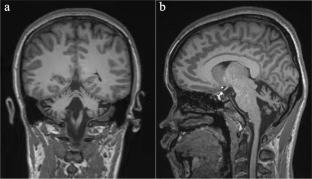 Transcranial Alternating Current Stimulation in a Patient with Ataxia-Ocular Apraxia 2: a Case Report.