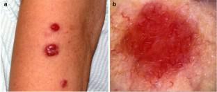 Non-invasive Skin Imaging in Cutaneous Lymphomas.