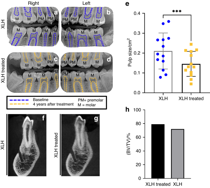 Dental impact of anti-fibroblast growth factor 23 therapy in X-linked hypophosphatemia.