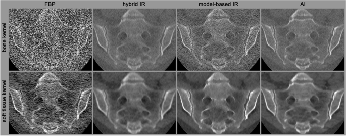 Future of Low-Dose Computed Tomography and Dual-Energy Computed Tomography in Axial Spondyloarthritis