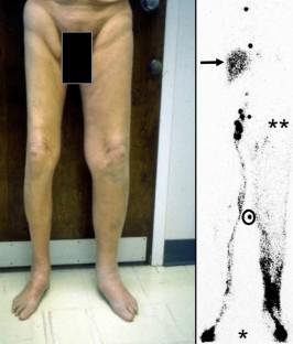 Etiology and treatment of cancer-related secondary lymphedema.