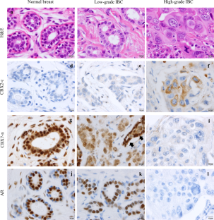 Subcellular expression pattern and clinical significance of CBX2 and CBX7 in breast cancer subtypes.