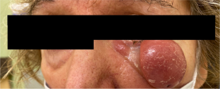 A case of clinically aggressive EBV-negative ENKTL in a non-Asian female patient.