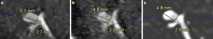 Ultra-High-Resolution Time-of-Flight MR-Angiography for the Noninvasive Assessment of Intracranial Aneurysms, Alternative to Preinterventional DSA?