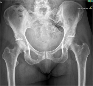 First report of lumbar spinal epidural hematoma after pelvic ring fracture.