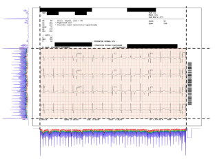 Extraction and Digitization of ECG Signals from Standard Clinical Portable Document Format Files for the Principal Component Analysis of T-wave Morphology.