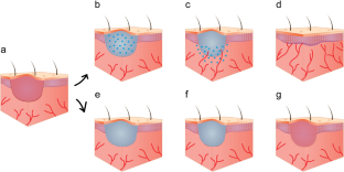 Functionalised biomaterials as synthetic extracellular matrices to promote vascularisation and healing of diabetic wounds.