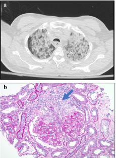 A Spotlight on Drug-Induced Vasculitis.