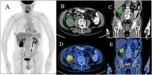 Diagnostic value of 18F-FDG PET/CT in primary and metastatic renal tumors: a pilot study