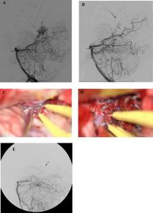 Treatment of Intracerebral Vascular Malformations: When to Intervene