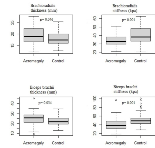 Assessment of forearm muscles with ultrasound shear wave elastography in patients with acromegaly.