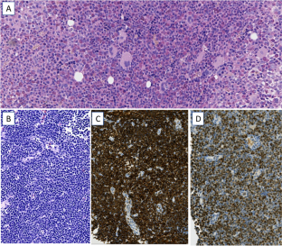 Myeloid and lymphoid neoplasm with novel complex translocation: unusual case report with T-lymphoblastic lymphoma, myeloid hyperplasia, eosinophilia, basophilia, and t(1;8;10)( (p31;q24;q11.2).