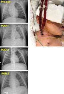 Veno-venous extracorporeal membrane oxygenation support of pulmonary insufficiency using Avalon Elite<sup>®</sup> cannula in pediatric patients.