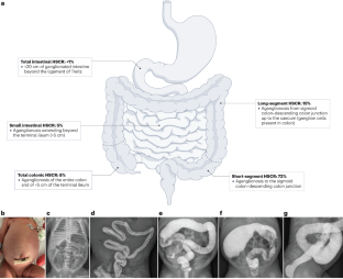 Hirschsprung disease.