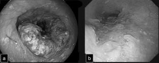 A case of perioperative artificial pancreas therapy for a patient with esophageal cancer with type 1 diabetes.