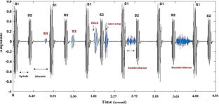 Effective features in the diagnosis of cardiovascular diseases through phonocardiogram