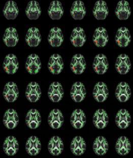 TBSS analysis of white matter fasciculus in chronic insomnia and the relationship with sleep quality and cognitive function.