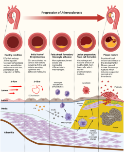 Role of Flow-Sensitive Endothelial Genes in Atherosclerosis and Antiatherogenic Therapeutics Development.