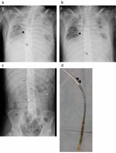 Abnormal stenosis of a drainage cannula due to excessive negative pressure during venovenous extracorporeal membrane oxygenation management: a case report.