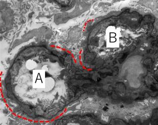 Morphological and etiological analyses of C3 and non-C3 glomerulonephritis in primary membranoproliferative glomerulonephritis using periodic acid-methenamine silver stain electron microscopy: a retrospective multicentered study.