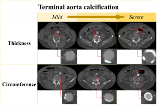 Side-by-side deployment of gore excluder legs at a narrow terminal aorta for endovascular aneurysm repair.