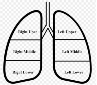 Influencing factors of lung shunt fraction in transarterial radioembolization treatment