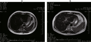 Iron overload due to SLC40A1 mutation of type 4 hereditary hemochromatosis.