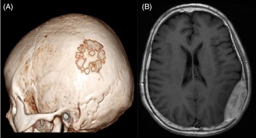 A 63-year-old woman with parietal scalp surface rugged