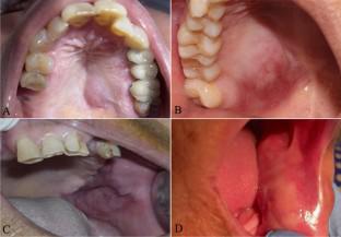 Oral follicular lymphoma: a clinicopathologic and molecular study