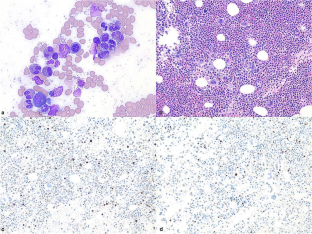 The value of next generation sequencing in the diagnosis of a rare cause of eosinophilia: B cell-acute lymphoblastic leukemia with t(5;14)(q31;q32)