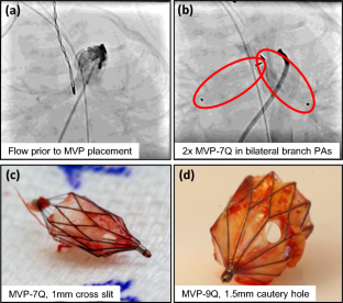 Transcatheter Pulmonary Artery Banding in High-Risk Neonates: In-Vitro Study Provoked by Initial Clinical Experience.