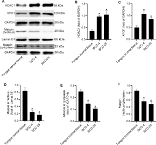 Selinexor assists vorinostat in inhibiting HDAC activity via promoting the accumulation of maspin in the nucleus of oral tongue squamous cell carcinoma cells.