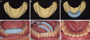 Survival rates of mandibular fixed retainers: comparison of a tube-type retainer and conventional multistrand retainers : A prospective randomized clinical trial.