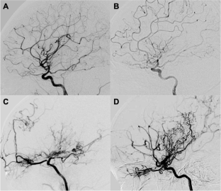 Nomogram to Predict Good Neoangiogenesis After Indirect Revascularization Surgery in Patients with Moyamoya Disease: a Case-control Study.